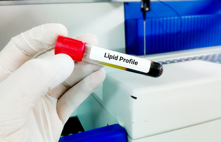 Lipid Profile Test in Ludhiana